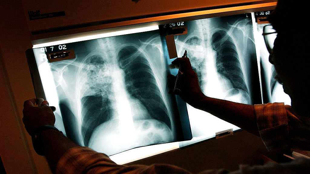 2 active tuberculosis cases traced to San Francisco strip club — KTVU FOX 2 Bay Area, Pleasanton Health news